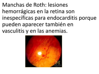 Nodule De Roth Endocarditis infecciosa | PPTX