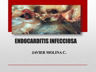 ENDOCARDITIS INFECCIOSA
JAVIER MOLINA C.
 