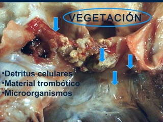 VEGETACIÓN




•Detritus celulares
•Material trombótico
•Microorganismos
 