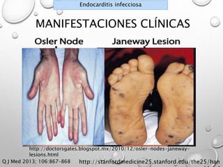 Endocarditis infecciosa 
MANIFESTACIONES CLÍNICAS 
http://stanfordmedicine25.stanford.edu/the25/han 
d.html 
http://doctorsgates.blogspot.mx/2010/12/osler-nodes-janeway-lesions. 
html 
Q J Med 2013; 106:867–868 
 