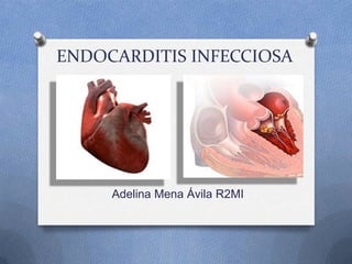 ENDOCARDITIS INFECCIOSA
Adelina Mena Ávila R2MI
 