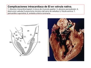 Complicaciones intracardiaca de EI en valvula nativa.
1, Absceso miocardico/septal; 2,rotura de musculo papilar; 3, absceso paravalvular; 4,
destrucion valvular;5,aneurisma micotico del seno de valsalva; 6, fistula aortica; 7,
pericarditis supurativa; 8, embolia arteria coronaria.
 