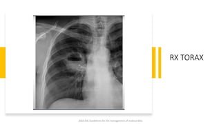 RX TORAX
2023 ESC Guidelines for the management of endocarditis
 