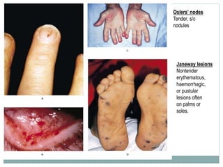 Oslers’ nodes
Tender, s/c
nodules
Janeway lesions
Nontender
erythematous,
haemorrhagic,
or pustular
lesions often
on palms or
soles.
 