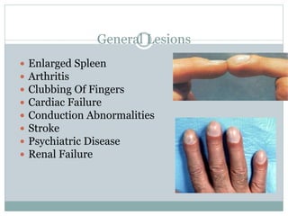 General Lesions
 Enlarged Spleen
 Arthritis
 Clubbing Of Fingers
 Cardiac Failure
 Conduction Abnormalities
 Stroke
 Psychiatric Disease
 Renal Failure
 