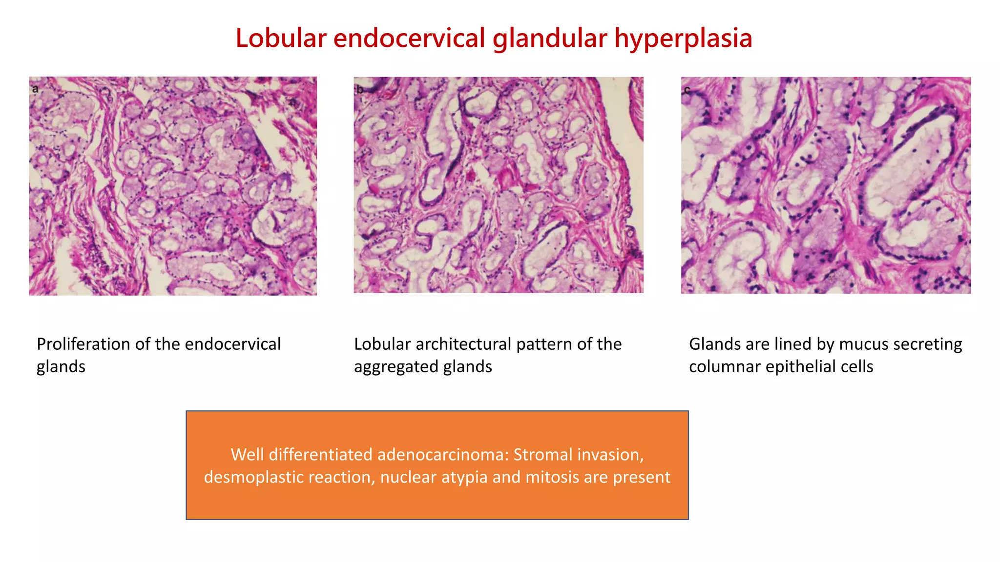 Diagnostic challenges in endocervical adenocarcinoma | PPTX
