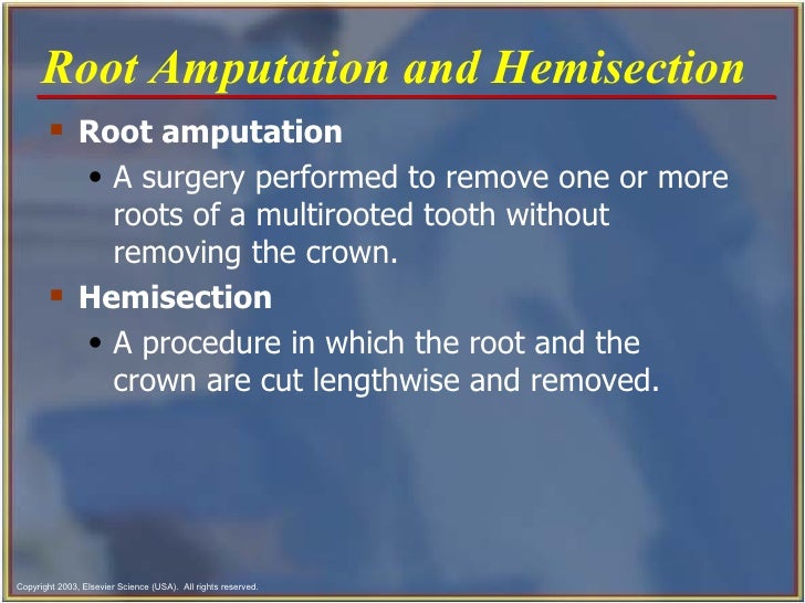Endodontics Chapter 54
