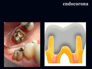 endocoronaendocorona
 