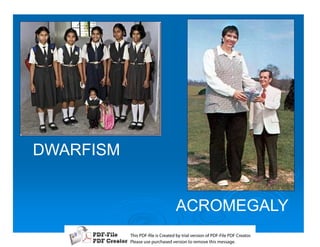 DWARFISM


                        ACROMEGALY
           T iP F liCetd yr les n f D -lP F rao.
           h D - es rae b tavro o P F i D Cetr
             s              i    i     Fe
           P ae s p r ae vro t rmoe h mesg .
            l s ue uc sd es n o e v ti s e
            e        h     i         s   a
 