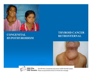 THYROID CANCER
CONGENITAL                           RETROSTERNAL
HYPOTHYROIDISM




                 T iP F liCetd yr les n f D -lP F rao.
                 h D - es rae b tavro o P F i D Cetr
                   s              i    i     Fe
                 P ae s p r ae vro t rmoe h mesg .
                  l s ue uc sd es n o e v ti s e
                  e        h     i         s   a
 