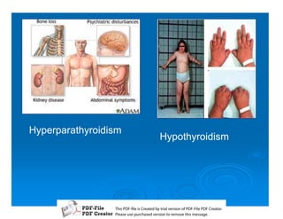 Hyperparathyroidism
                               Hypothyroidism




                 T iP F liCetd yr les n f D -lP F rao.
                 h D - es rae b tavro o P F i D Cetr
                   s              i    i     Fe
                 P ae s p r ae vro t rmoe h mesg .
                  l s ue uc sd es n o e v ti s e
                  e        h     i         s   a
 