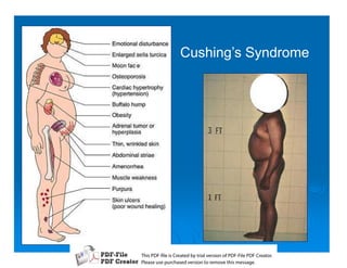 Cushing’s Syndrome




T iP F liCetd yr les n f D -lP F rao.
h D - es rae b tavro o P F i D Cetr
  s              i    i     Fe
P ae s p r ae vro t rmoe h mesg .
 l s ue uc sd es n o e v ti s e
 e        h     i         s   a
 