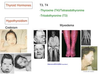 Thyroid Hormones T3, T4 
-Thyroxine (T4)/Tetraiodothyronine 
-Triiodothyronine (T3) 
Hypothyroidism 
Cretinism Myxedema 
 