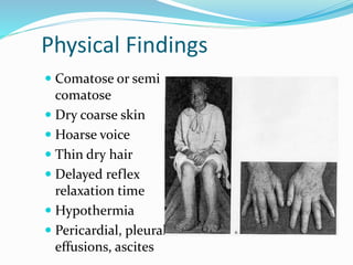 Physical Findings
 Comatose or semi
comatose
 Dry coarse skin
 Hoarse voice
 Thin dry hair
 Delayed reflex
relaxation time
 Hypothermia
 Pericardial, pleural
effusions, ascites
 