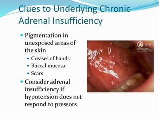Clues to Underlying Chronic
Adrenal Insufficiency
 Pigmentation in
unexposed areas of
the skin
 Creases of hands
 Buccal mucosa
 Scars
 Consider adrenal
insufficiency if
hypotension does not
respond to pressors
 