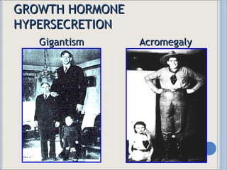 GROWTH HORMONE HYPERSECRETION Gigantism Prior to closure of the epiphyses;  proportional growth Acromegaly After closure of the epiphyses;  disproportional  growth 