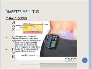 DIABETES MELLITUS Insulin pump Basal doses of regular insulin delivered every few minutes bolus doses delivered  pc Appropriate amount of insulin for 24 hours plus priming is drawn into syringe The administration set is primed and needle inserted aseptically, usually into abdomen 