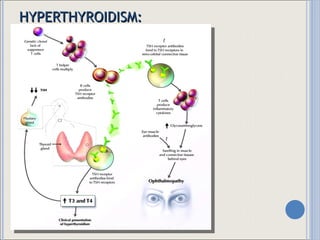 HYPERTHYROIDISM: CLINICAL MANIFESTATIONS 