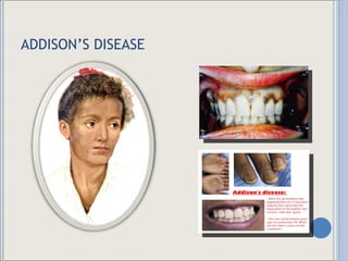 ADDISON’S DISEASE 