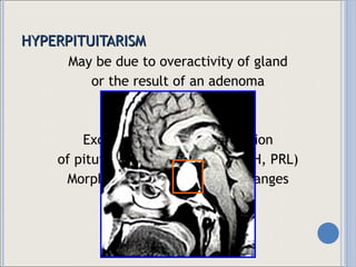 HYPERPITUITARISM May be due to overactivity of gland or the result of an adenoma Characterized by: Excessive serum concentration of pituitary hormones (GH, ACTH, PRL) Morphologic and functional changes in the anterior pituitary 