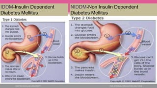 IDDM-Insulin Dependent
Diabetes Mellitus
NIDDM-Non Insulin Dependent
Diabetes Mellitus
 