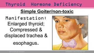 Simple Goiter/non-toxic
Manifestation:
Enlarged thyroid;
Compressed &
displaced trachea &
esophagus.
Thyroid Hormone Deficiency
 