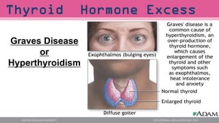 Graves Disease
or
Hyperthyroidism
Thyroid Hormone Excess
 