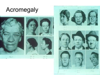 Acromegaly
 