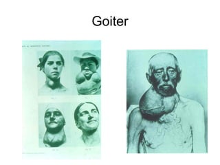 Goiter
 