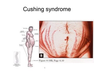 Cushing syndrome
 