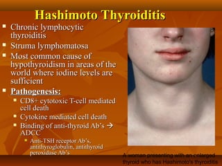 Hashimoto ThyroiditisHashimoto Thyroiditis
 Chronic lymphocyticChronic lymphocytic
thyroiditisthyroiditis
 Struma lymphomatosaStruma lymphomatosa
 Most common cause ofMost common cause of
hypothyroidism in areas of thehypothyroidism in areas of the
world where iodine levels areworld where iodine levels are
sufficientsufficient
 Pathogenesis:Pathogenesis:
 CD8+ cytotoxic T-cell mediatedCD8+ cytotoxic T-cell mediated
cell deathcell death
 Cytokine mediated cell deathCytokine mediated cell death
 Binding of anti-thyroid Ab’sBinding of anti-thyroid Ab’s 
ADCCADCC
 Anti-TSH receptor Ab’s,Anti-TSH receptor Ab’s,
antithyroglobulin, antithyroidantithyroglobulin, antithyroid
peroxidase Ab’speroxidase Ab’s A woman presenting with an enlarged
thyroid who has Hashimoto's thyroiditis
 