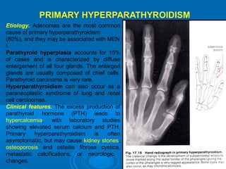 Etiology. Adenomas are the most common
cause of primary hyperparathyroidism
(80%), and they may be associated with MEN
I.
Parathyroid hyperplasia accounts for 15%
of cases and is characterized by diffuse
enlargement of all four glands. The enlarged
glands are usually composed of chief cells.
Parathyroid carcinoma is very rare.
Hyperparathyroidism can also occur as a
paraneoplastic syndrome of lung and renal
cell carcinomas.
Clinical features. The excess production of
parathyroid hormone (PTH) leads to
hypercalcemia, with laboratory studies
showing elevated serum calcium and PTH.
Primary hyperparathyroidism is often
asymptomatic, but may cause kidney stones;
osteoporosis and osteitis fibrosa cystica,
metastatic calcifications, or neurologic
changes.
 