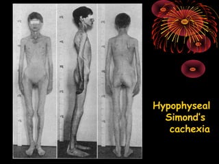 Hypophyseal
Simond’s
cachexia
 
