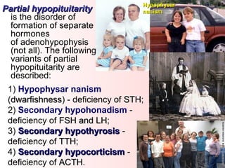 Partial hypopituitarityPartial hypopituitarity
is the disorder of
formation of separate
hormones
of adenohypophysis
(not all). The following
variants of partial
hypopituitarity are
described:
HypophysarHypophysar
nanismnanism
1) Hypophysar nanism
(dwarfishnessdwarfishness) - deficiency of STHSTH;
2) Secondary hypohonadism -
deficiency of FSH and LHFSH and LH;
3) Secondary hypothyrosisSecondary hypothyrosis -
deficiency of TTHTTH;
4) Secondary hypocorticismSecondary hypocorticism -
deficiency of ACTHACTH.
 