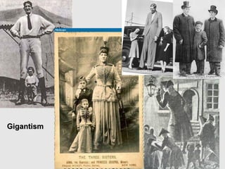 GigantismGigantism
 