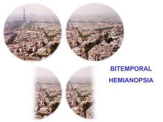 BITEMPORAL
HEMIANOPSIA
 