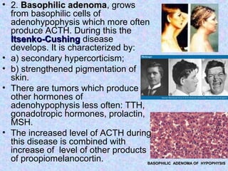 • 2. Basophilic adenomaBasophilic adenoma, grows
from basophilic cells of
adenohypophysis which more often
produce ACTH. During this the
Itsenko-CushingItsenko-Cushing disease
develops. It is characterized by:
• а) secondary hypercorticism;
• b) strengthened pigmentation of
skin.
• There are tumors which produce
other hormones of
adenohypophysis less often: TTH,
gonadotropic hormones, prolactin,
MSH.
• The increased level of ACTH during
this disease is combined with
increase of level of other products
of proopiomelanocortin. BASOPHILIC ADENOMA OF HYPOPHYSISBASOPHILIC ADENOMA OF HYPOPHYSIS
 