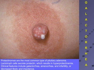 GG
AA
LL
AA
CC
TT
OO
RR
RR
HH
EE
AA
Prolactinomas are the most common type of pituitary adenoma.
Lactotroph cells secrete prolactin, which results in hyperprolactinemia.
Clinical features include galactorrhea, amenorrhea, and infertility, or
decreased libido and impotence.
 