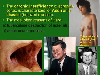 • TheThe chronic insufficiencychronic insufficiency of adrenalsof adrenals
cortex is characterized forcortex is characterized for Addison’sAddison’s
diseasedisease (bronzed disease).(bronzed disease).
• The most often reasons of it are:The most often reasons of it are:
а) tuberculose destruction of adrenals;
b) autoimmune process.
Tuberculose of
adrenal gland.
Adison’s
disease
 