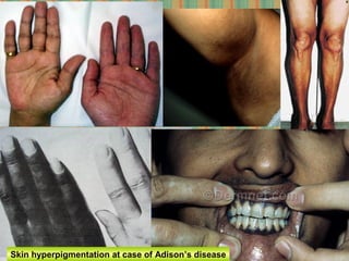 Skin hyperpigmentation at case of Adison’s disease
 