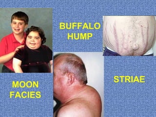 MOON
FACIES
BUFFALO
HUMP
STRIAE
 