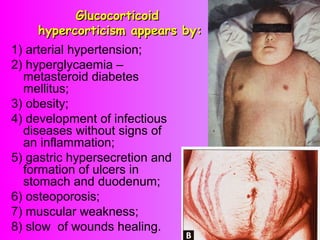 GlucocorticoidGlucocorticoid
hypercorticism appears by:hypercorticism appears by:
1) arterial hypertension;
2) hyperglycaemia –
metasteroid diabetes
mellitus;
3) obesity;
4) development of infectious
diseases without signs of
an inflammation;
5) gastric hypersecretion and
formation of ulcers in
stomach and duodenum;
6) osteoporosis;
7) muscular weakness;
8) slow of wounds healing.
 