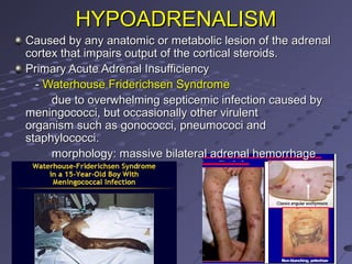 HYPOADRENALISMHYPOADRENALISM
Caused by any anatomic or metabolic lesion of the adrenalCaused by any anatomic or metabolic lesion of the adrenal
cortex that impairs output of the cortical steroids.cortex that impairs output of the cortical steroids.
Primary Acute Adrenal InsufficiencyPrimary Acute Adrenal Insufficiency
-- Waterhouse Friderichsen SyndromeWaterhouse Friderichsen Syndrome
due to overwhelming septicemic infection caused bydue to overwhelming septicemic infection caused by
meningococci, but occasionally other virulentmeningococci, but occasionally other virulent
organism such as gonococci, pneumococi andorganism such as gonococci, pneumococi and
staphylococci.staphylococci.
morphology: massive bilateral adrenal hemorrhagemorphology: massive bilateral adrenal hemorrhage
 