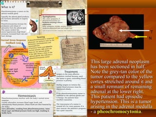  This large adrenal neoplasmThis large adrenal neoplasm
has been sectioned in half.has been sectioned in half.
Note the grey-tan color of theNote the grey-tan color of the
tumor compared to the yellowtumor compared to the yellow
cortex stretched around it andcortex stretched around it and
a small remnant of remaininga small remnant of remaining
adrenal at the lower right.adrenal at the lower right.
This patient had episodicThis patient had episodic
hypertension. This is a tumorhypertension. This is a tumor
arising in the adrenal medullaarising in the adrenal medulla
- a- a pheochromocytomapheochromocytoma..
T
N
 