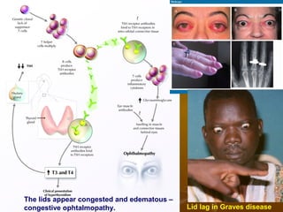 Lid lag in Graves disease
The lids appear congested and edematous –
congestive ophtalmopathy.
 