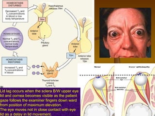 Lid lag occurs when the sclera B/W upper eye
lid and cornea becomes visible as the patient
gaze follows the examiner fingers down ward
from position of maximum elevation.
The eye moves not in close contact with eye
lid as a delay in lid movement.
 