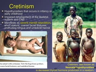 CretinismCretinism
Hypothyroidism that occurs in infancy orHypothyroidism that occurs in infancy or
early childhoodearly childhood
Impaired development of the skeletalImpaired development of the skeletal
system and CNSsystem and CNS
Manifests asManifests as severe mental retardationsevere mental retardation,,
short stature, coarse facial features,short stature, coarse facial features,
protruding tongue and umbilical herniaprotruding tongue and umbilical hernia
Cretinism, also known as
Neonatal hypothyroidism
is decreased thyroid hormone production in a newborn.
 