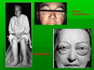 PrimaryPrimary
hypotyrioidismhypotyrioidism
MyxedemaMyxedema
 