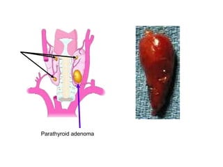 Parathyroid adenoma
 