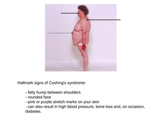 Hallmark signs of Cushing's syndrome:
- fatty hump between shoulders
- rounded face
- pink or purple stretch marks on your skin
- can also result in high blood pressure, bone loss and, on occasion,
diabetes.
 